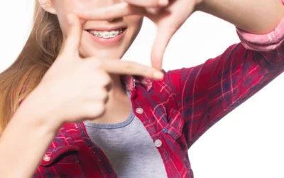 How Long Do I Have to Wear Braces?